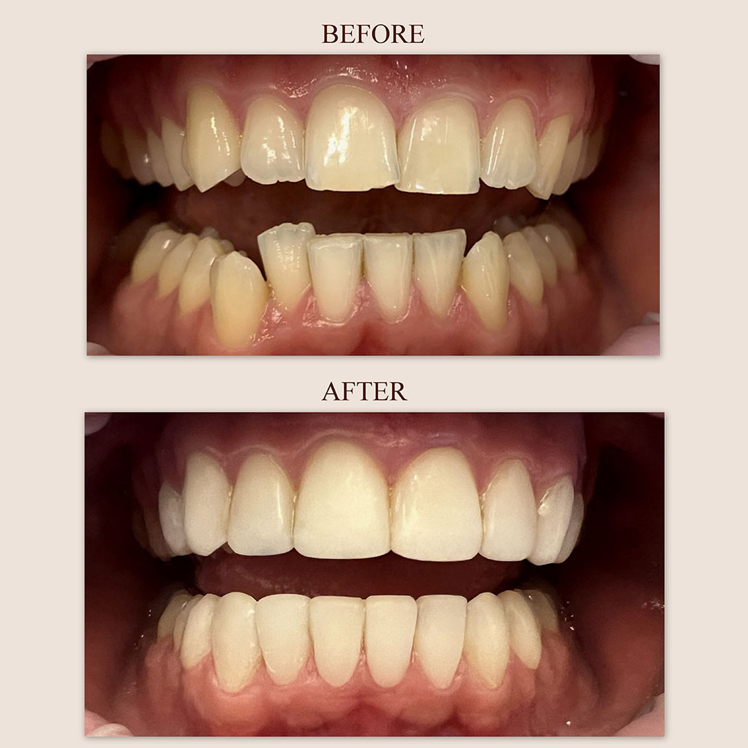 teeth-whi-2