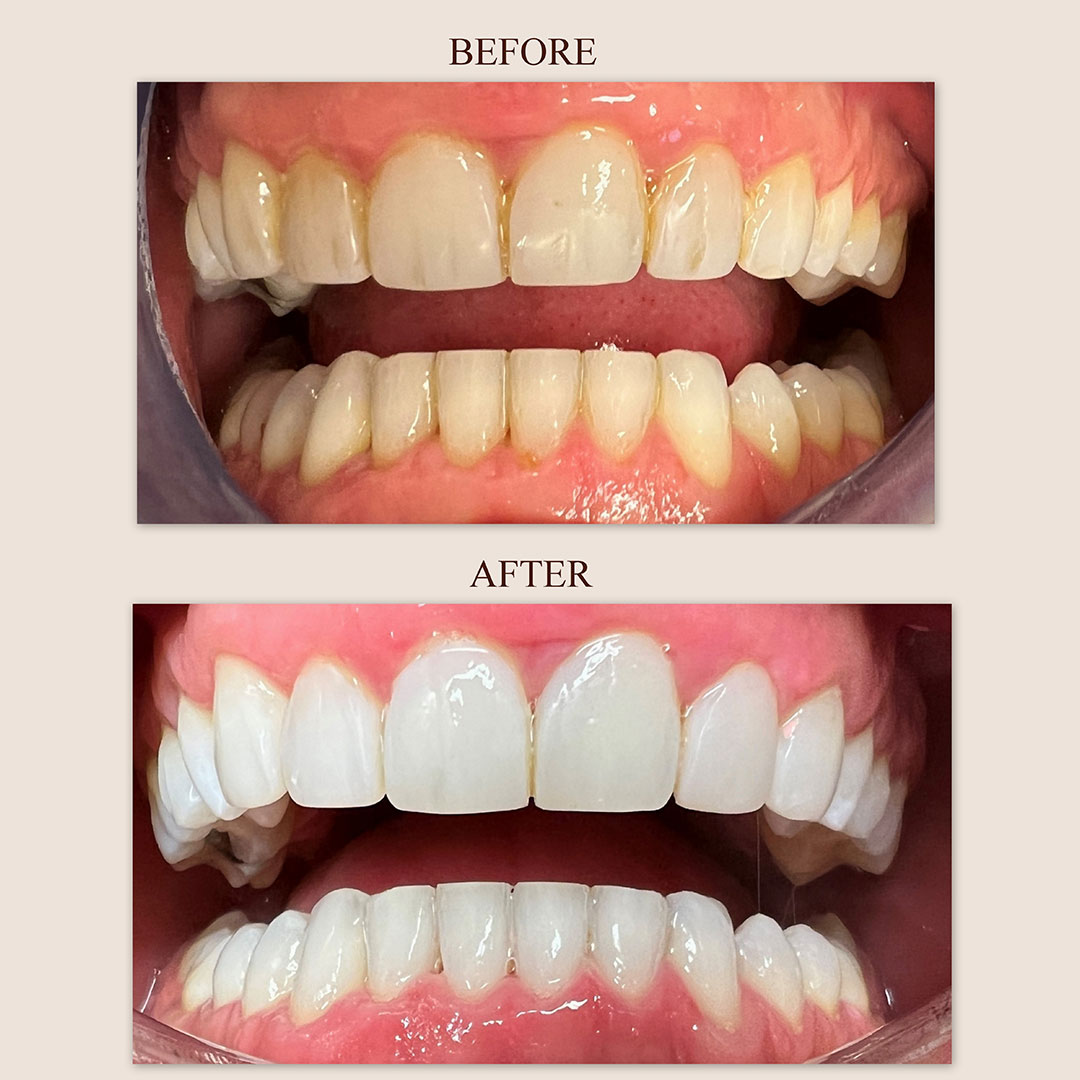 teeth-whi-4