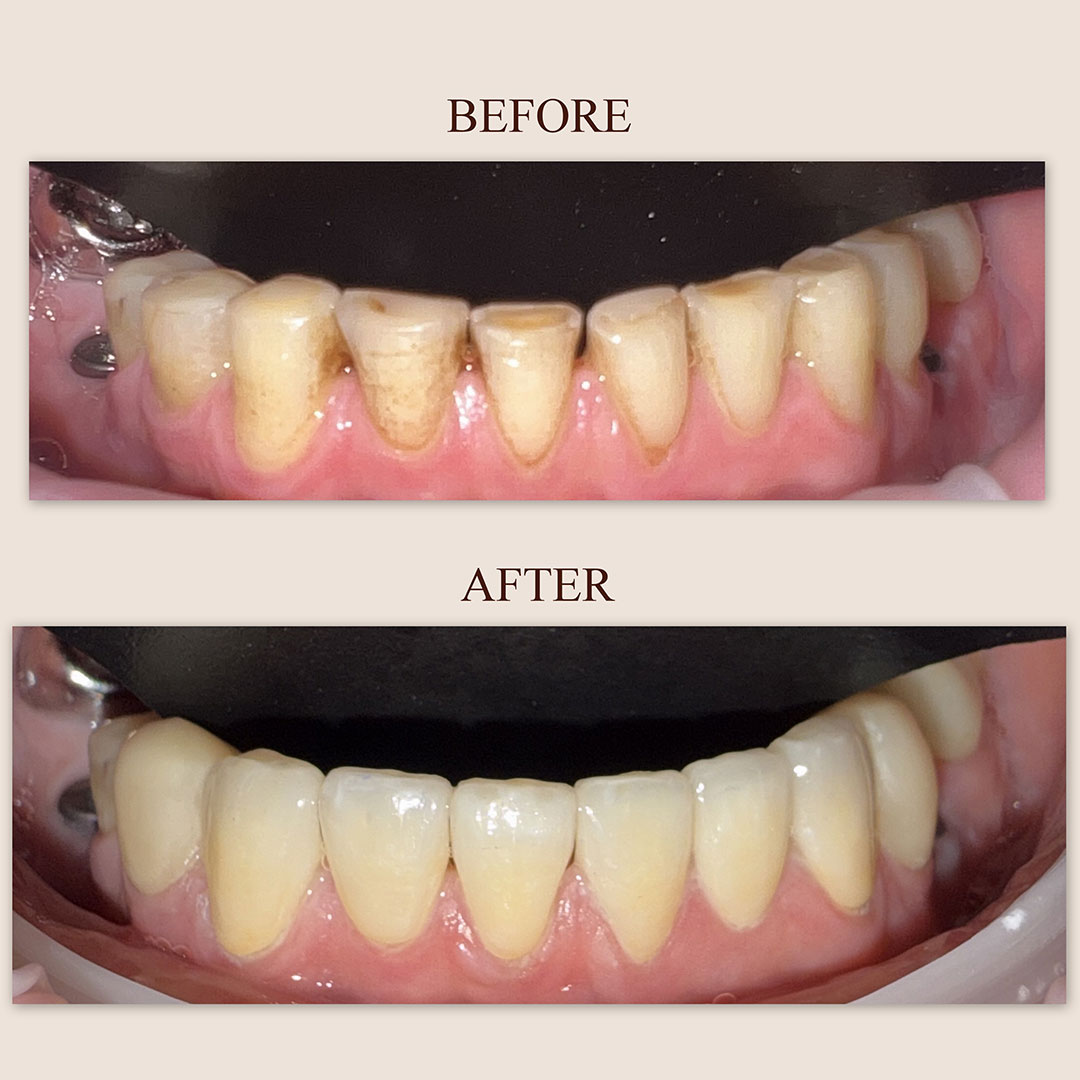 veneer-1