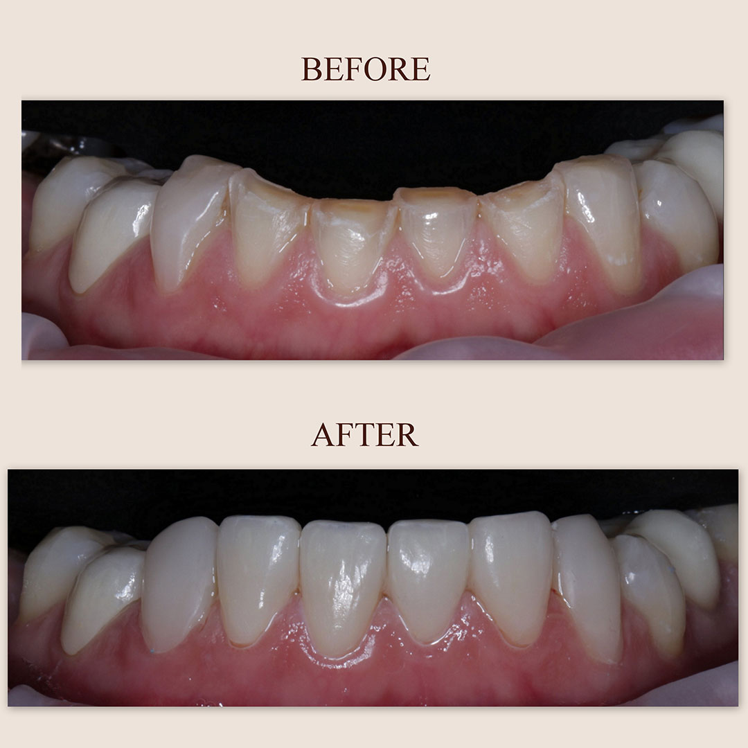 veneer-2